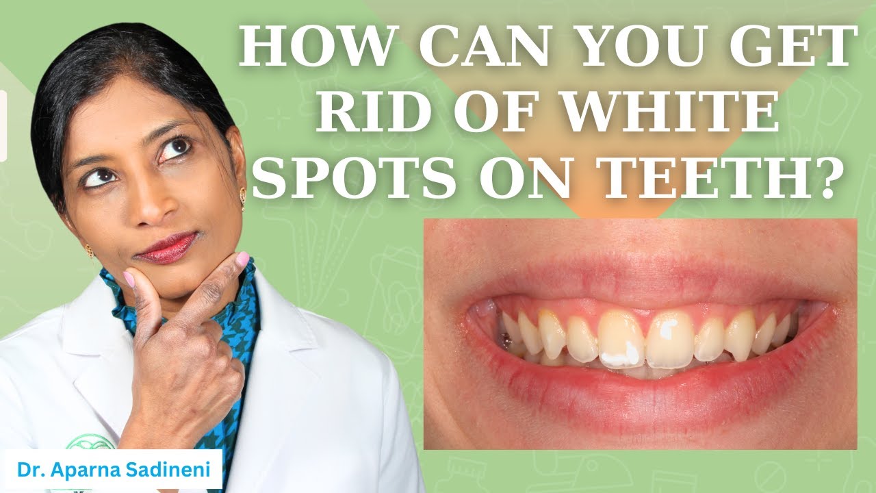 Understanding White Spot Removal Technology at Dublin Metro Dental | Cosmetic Dentist in Columbus