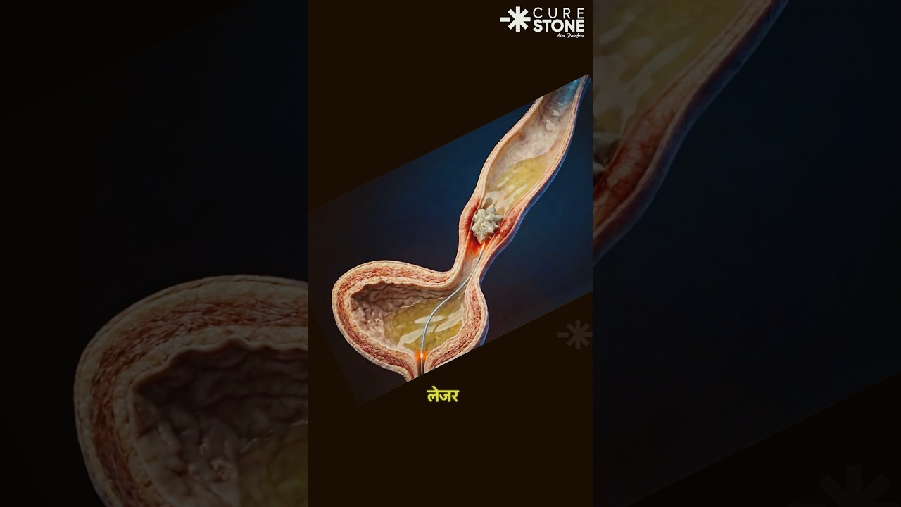 VUJ Stone Treatment | How VUJ(vesicoureteric ) stone is treated 