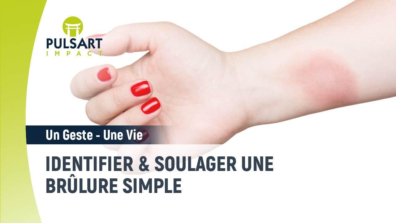 Identifier et soulager une brûlure simple