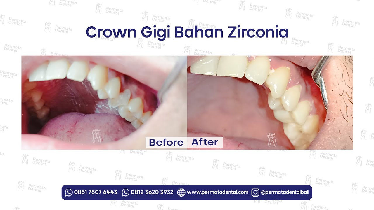 Proses Pembuatan & Pemasangan Gigi Crown Berbahan Zirconia di Permata Dental #5