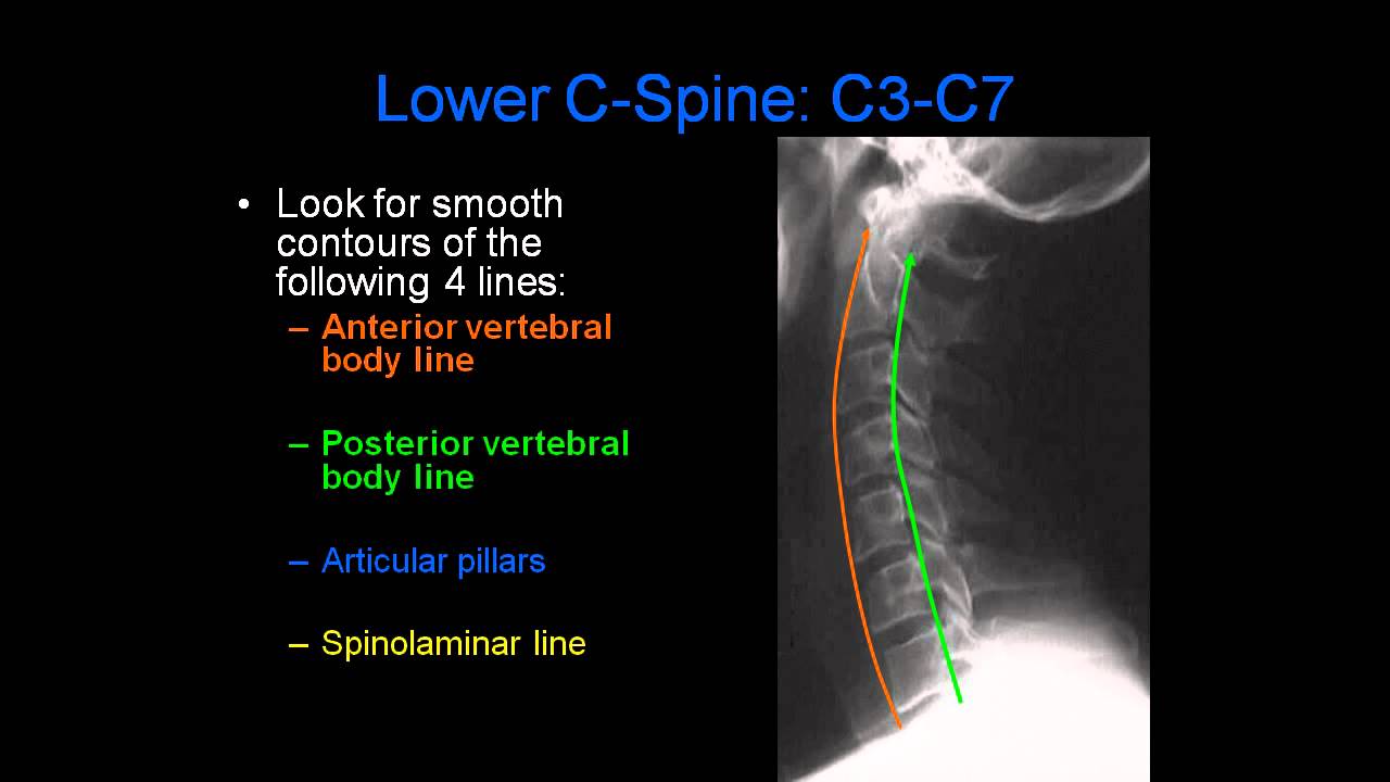Radiology of Spine Trauma