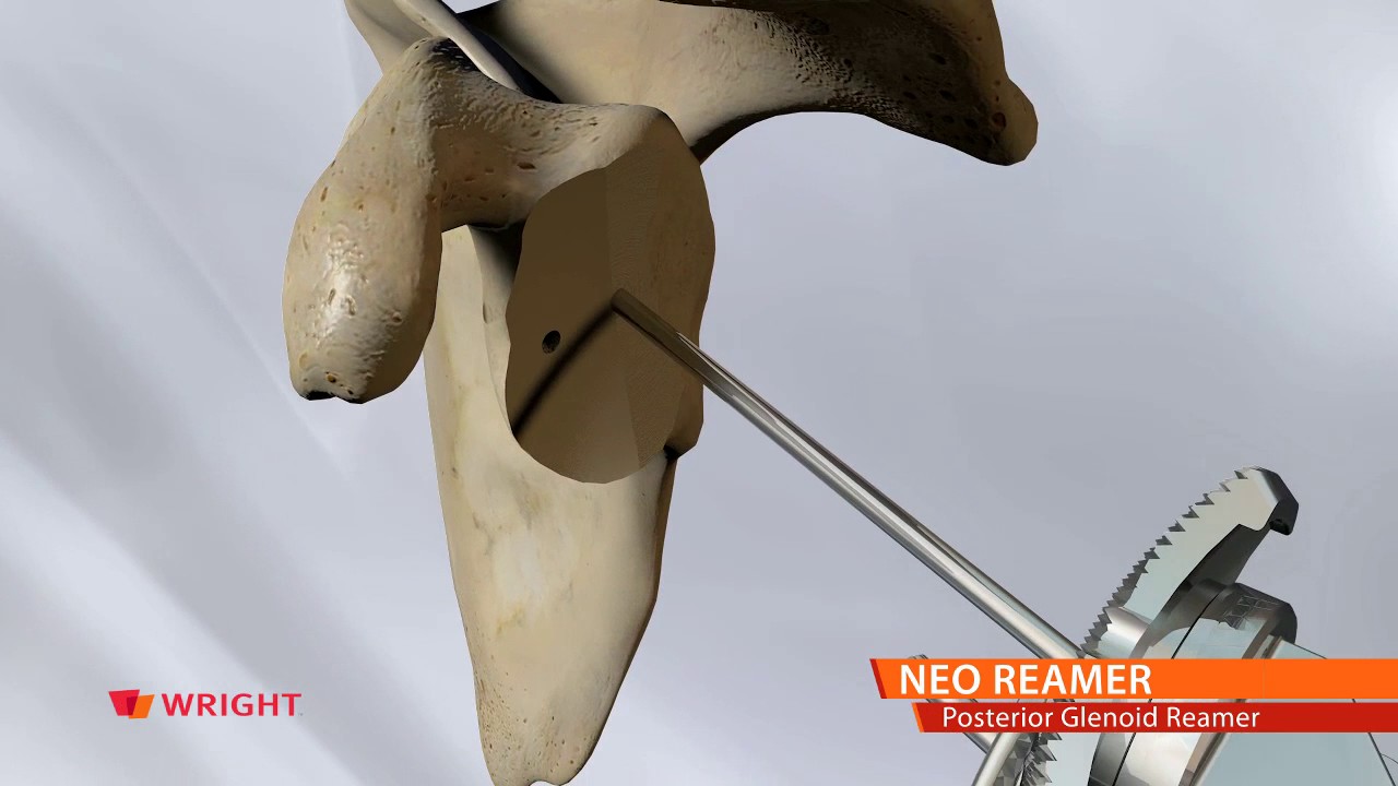 AEQUALIS&trade; PERFORM&trade;+ Shoulder System_NEO REAMER Animation