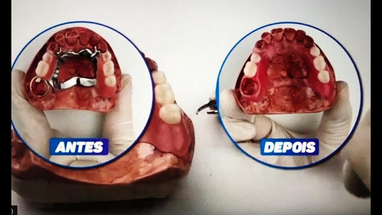 Cansado Da Sua Prótese De Metal? Conheça a Prótese Flexível!