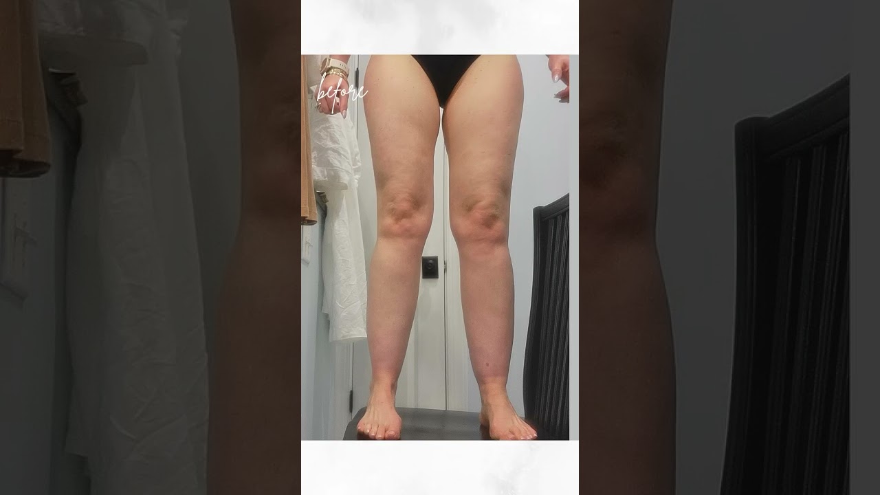Amazing Before and After Transformation  #lipedemaawareness #beforeandafter