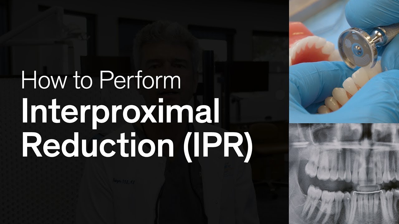 How to Perform IPR for Clear Aligners | Smilers®