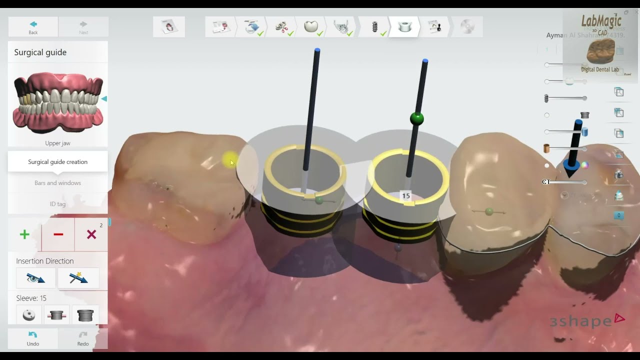 3Shape Implant Studio 2020: Detailed Workflow