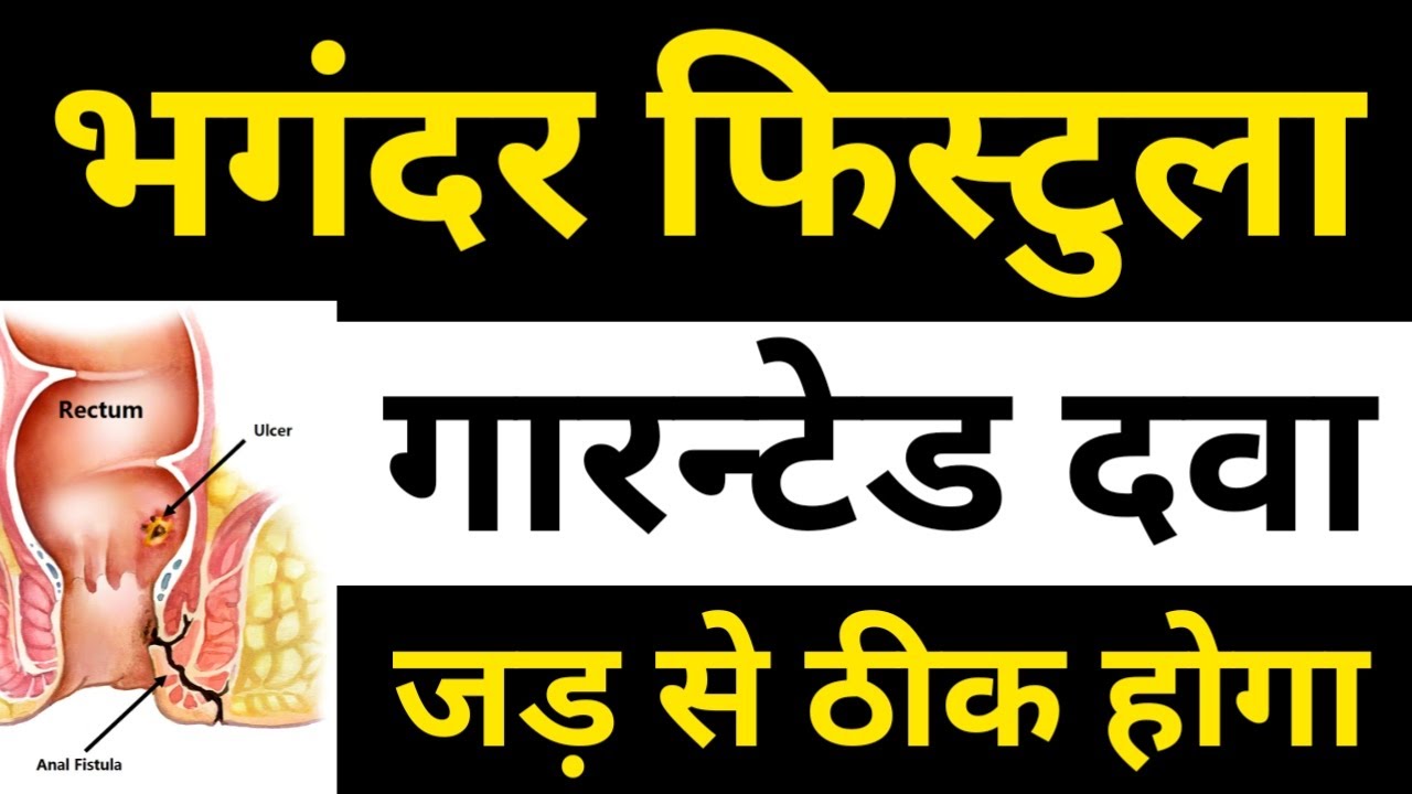 फिस्टुला(Fistula)रामबाण इलाज,फिस्टुला का होम्योपैथिक उपचार || फिस्टुला की होम्योपैथिक में मेडिसिन
