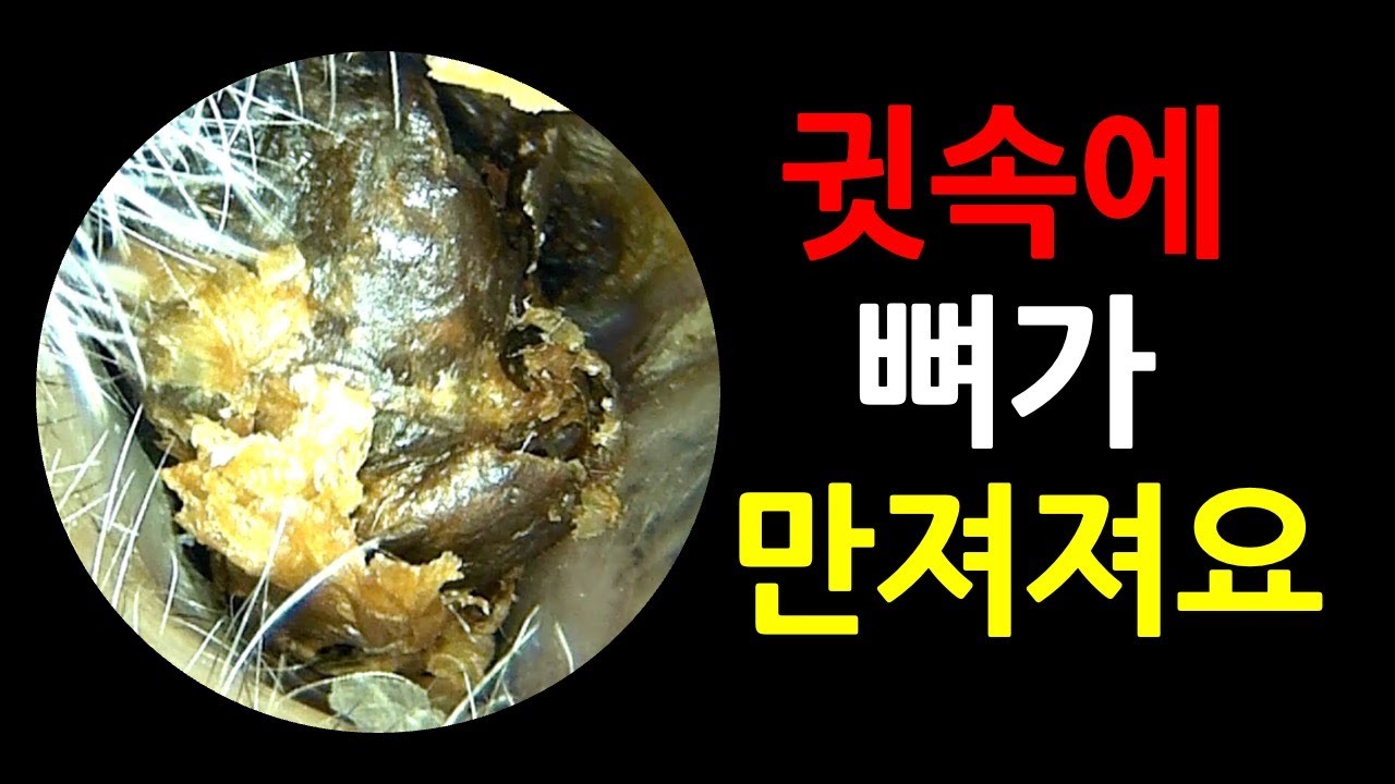 2025년이 얼마 안 남았는데 아무 생각없는 이비인후과 귀지제거 내시경 영상 #earwax