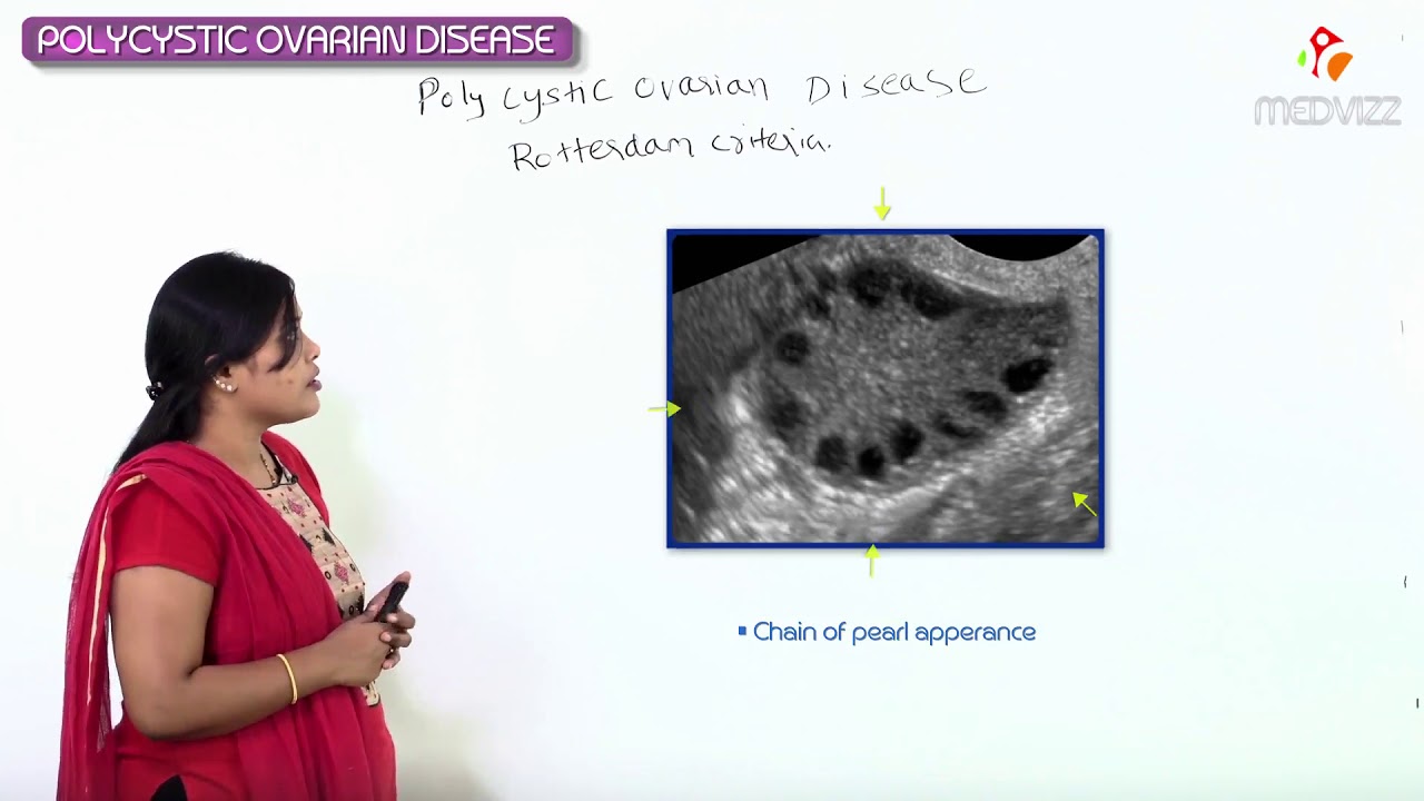 Polycystic ovary syndrome (PCOS) Part-1 - OBG / GYNE for Fmge and Neet pg by Dr Ramya sree