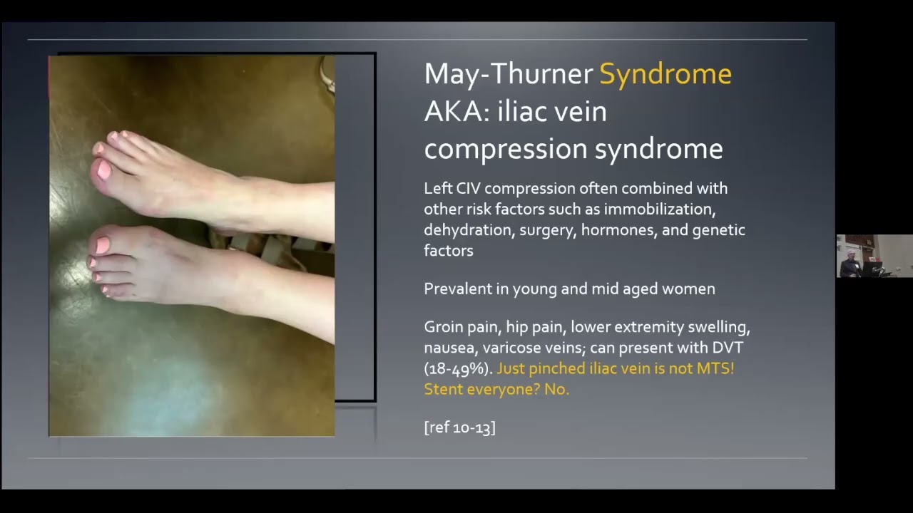 Pelvic Venous Disorders in EDS | Steven Smith, MD