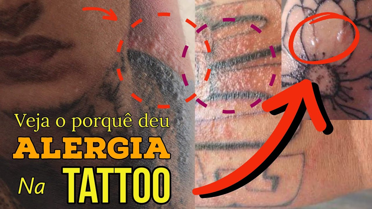 🔴 Reação ALÉRGICA na TATTOO