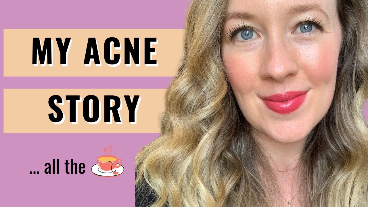 My Acne Story & How I Finally Got Clear