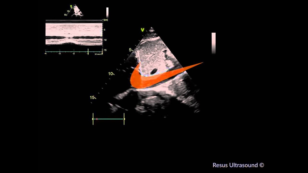 7 minutes IVC ultrasound part 1