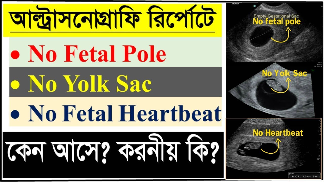 1st USG Report during Pregnancy। No fetal pole। No Yolk Sac । No fetal heartbeat. আসলে কি করনীয়?