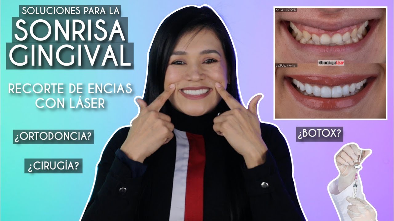 Sonrisa Gingival ¿Cómo eliminarla? ¿Botox? ¿Cirugía? ¿Ortodoncia? - Odontología Láser.