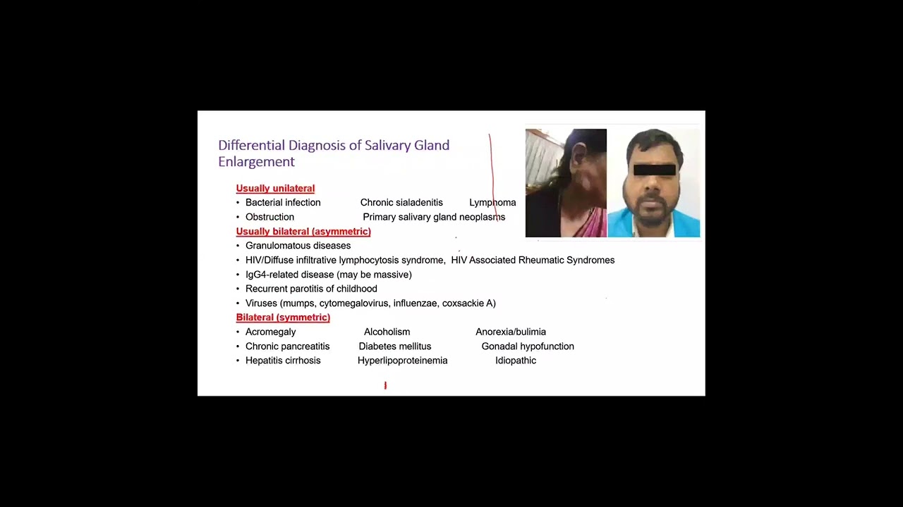 Sjogren syndrome update Prof Hoda Abdelbadie, internal medicine Immunology & Rheumatology, Fayoum