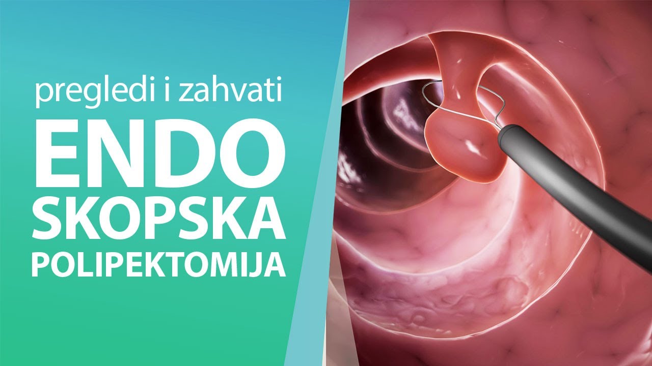 Poliklinika Amruševa: Endoskopska polipektomija