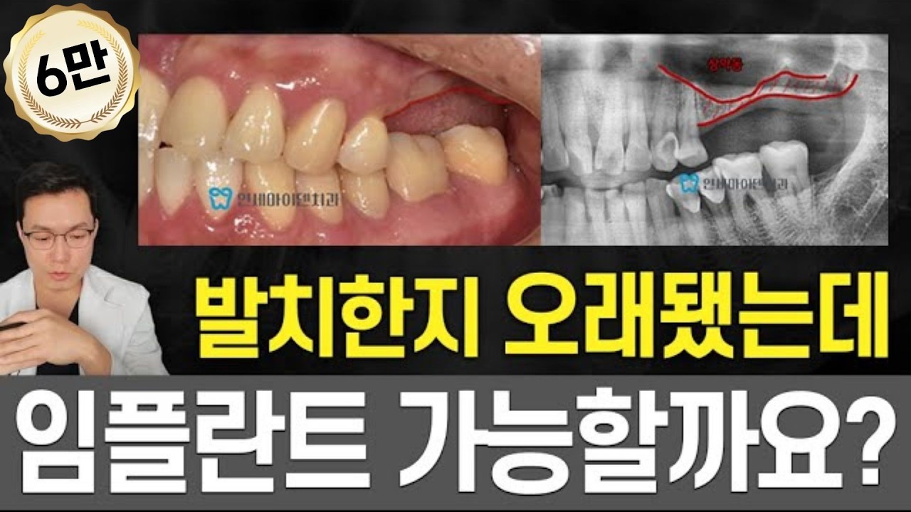 치아 상실한지 오래됐는데 임플란트 가능할까요?ㅠㅠ 상악동도 내려앉고 잇몸뼈도 부족하다?! 다 방법이 있습니다⭕️ 상악동거상술 후 뼈이식 임플란트 성공케이스!
