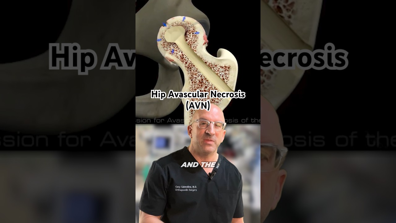 Check-out 👀 Hip Joint Damage from Avascular Necrosis #shorts