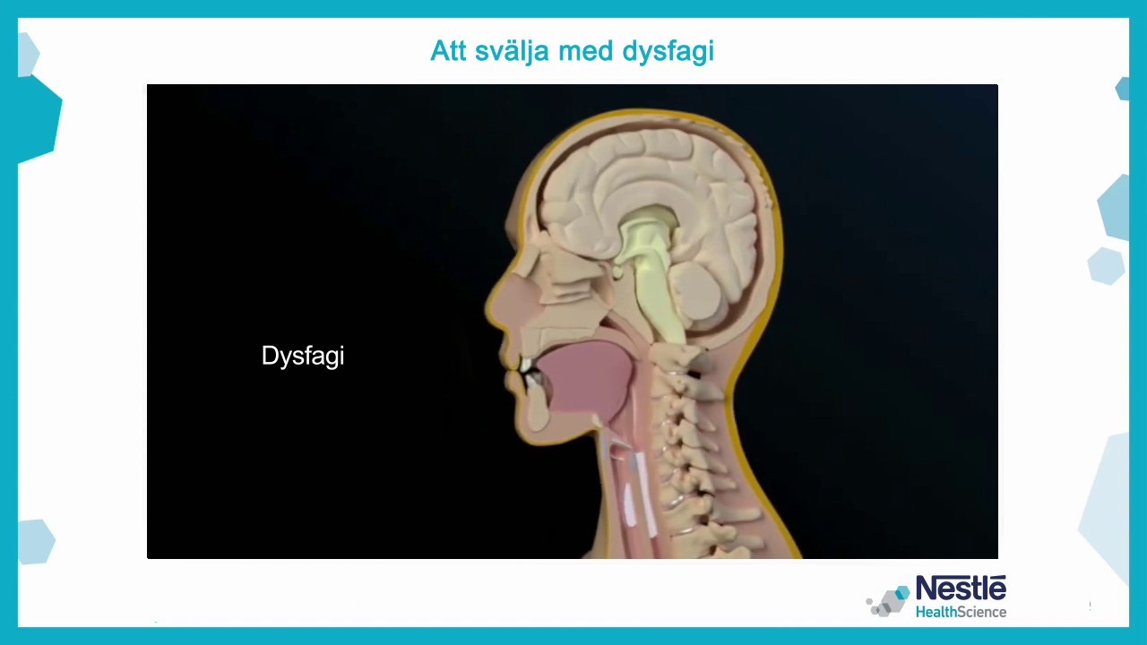 Att svälja med dysfagi