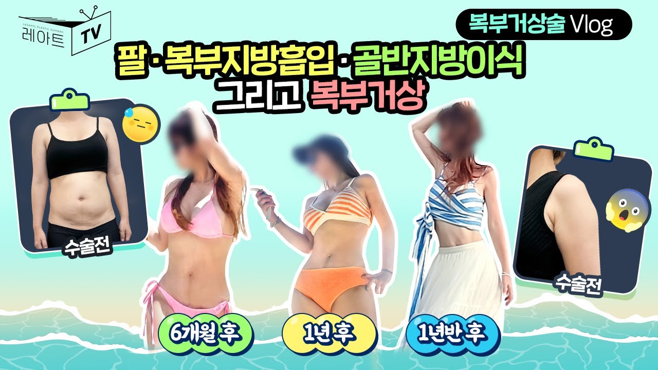 [복부거상수술]1년반 후 관리상태 괜찮나요? 옷사느라 재정상태가 안괜찮아요..🤣👙⛱[레아트성형외과]