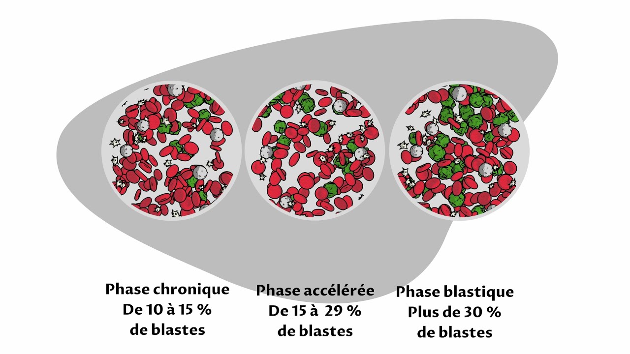 Options de traitement pour la leucémie myéloïde chronique