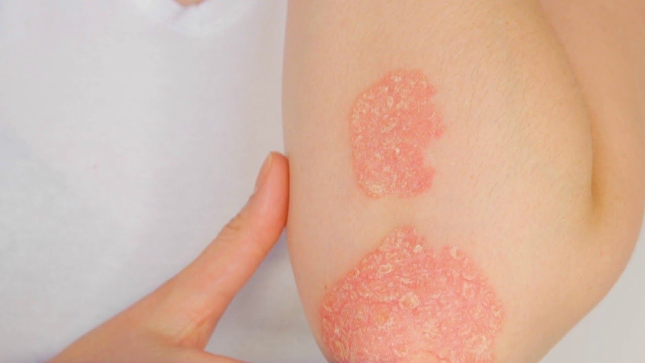 Santé - Psoriasis : attention au froid !