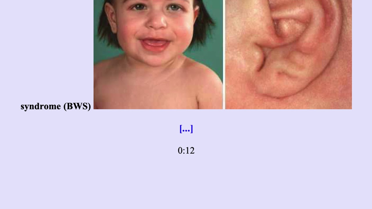 Wilm's Tumor Nephroblastoma - USMLE Step 2CK