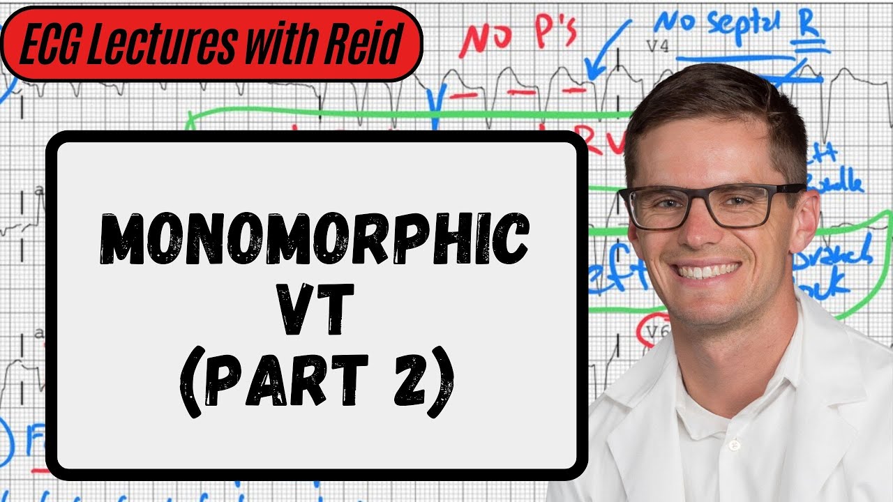 Monomorphic VT (Part 2) | Day 22 ECG Challenge