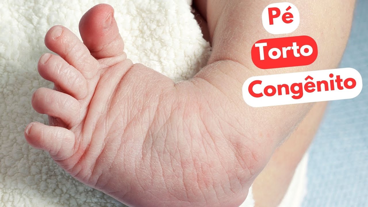 Pé Torto Congenito - Fisioterapia - Dr. Prof. Nelson Marques