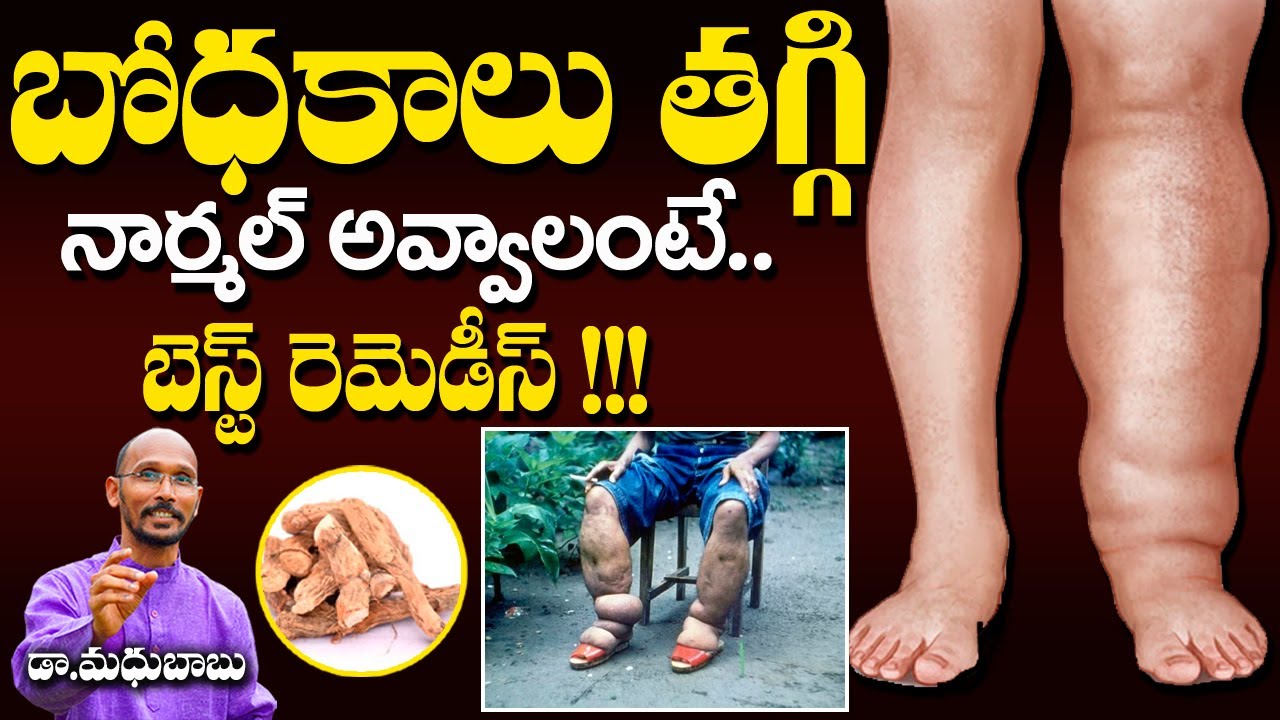 బోధకాలు తగ్గి నార్మల్ అవ్వాలంటే బెస్ట్ రెమెడీస్ | Dr. Madhu Babu | Health Trends |