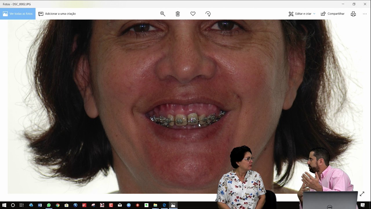 Jucelita fala sua experiência com a cirurgia ortognática (classe II)