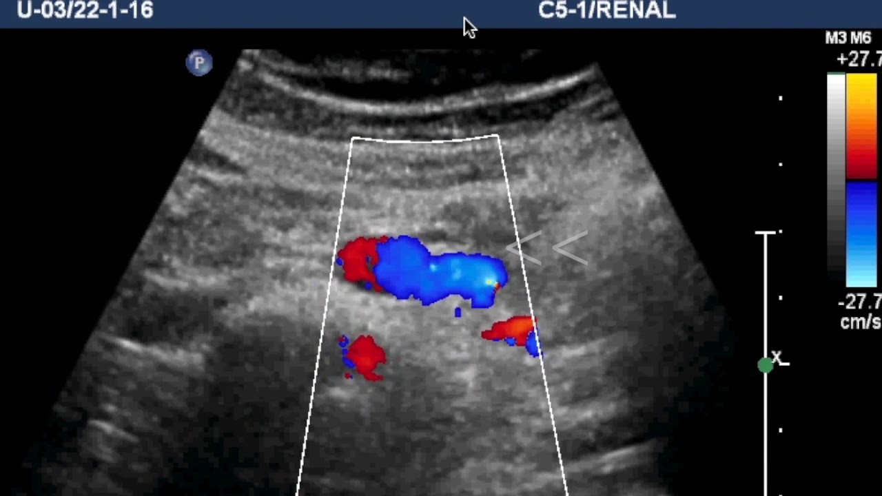 TMT: Renal Doppler Part III: Assessing Renal Artery Stenosis