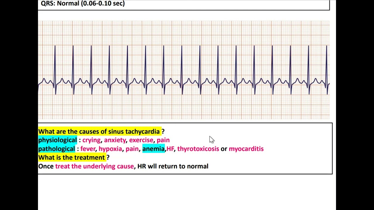 Pediatric Arrhythmias 1