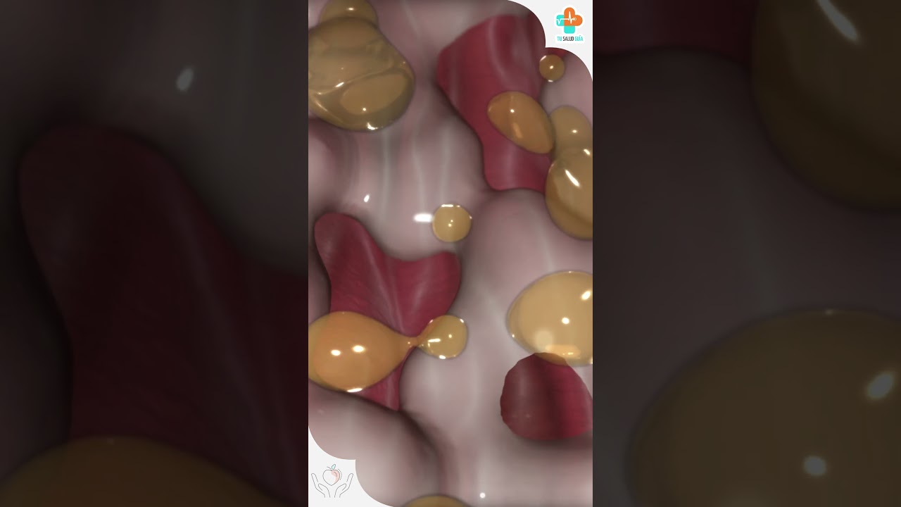 😣 &iquest;Sab&iacute;as que una &uacute;lcera g&aacute;strica es una herida abierta? 😨 | Tu Salud Gu&iacute;a