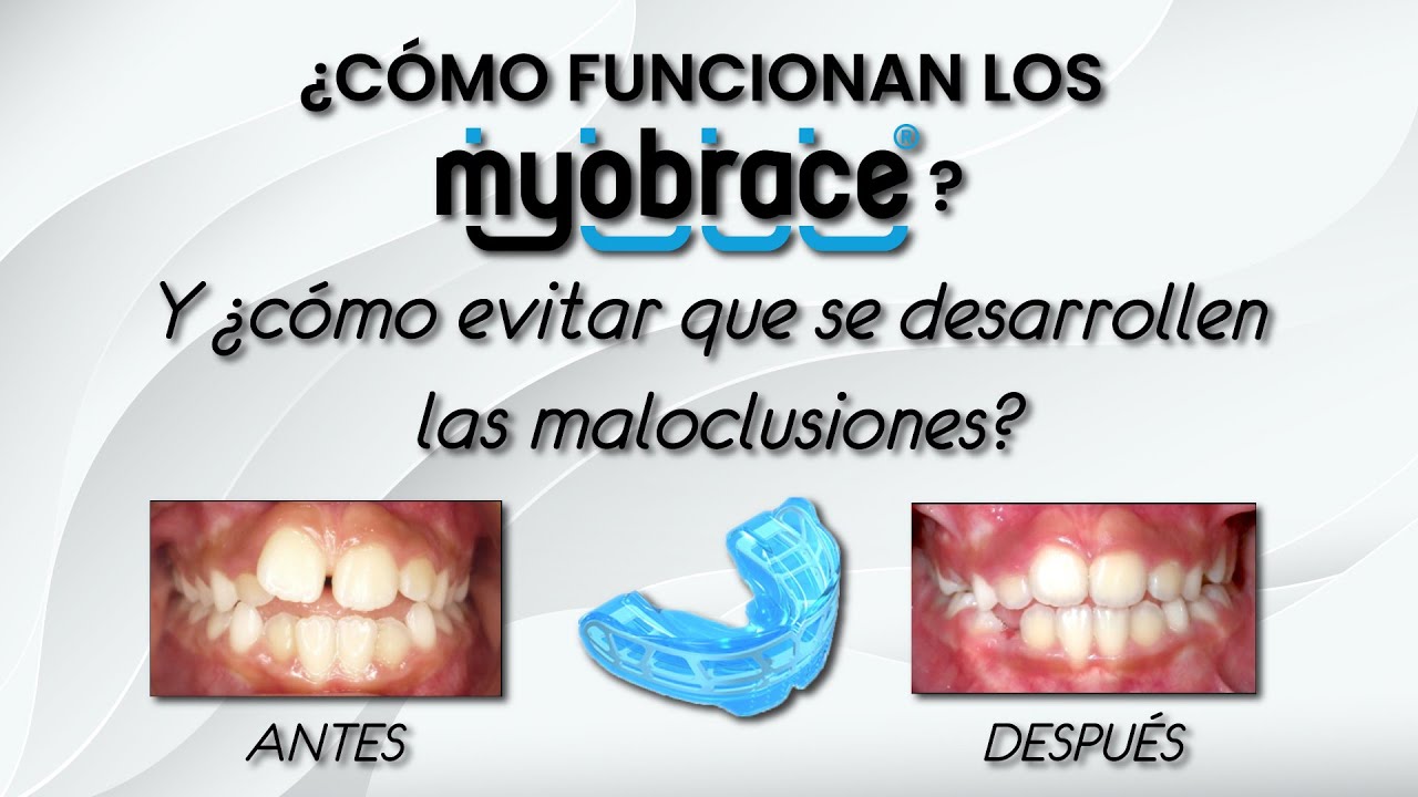 ¿Cómo funcionan los MYOBRACE? y ¿Cómo EVITAR que se desarrollen las MALOCLUSIONES?