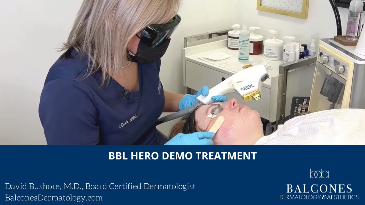 BBL® HERO Laser Treatment Demo | David Bushore, MD, FAAD | Austin, TX | Ph: 512-459-4869