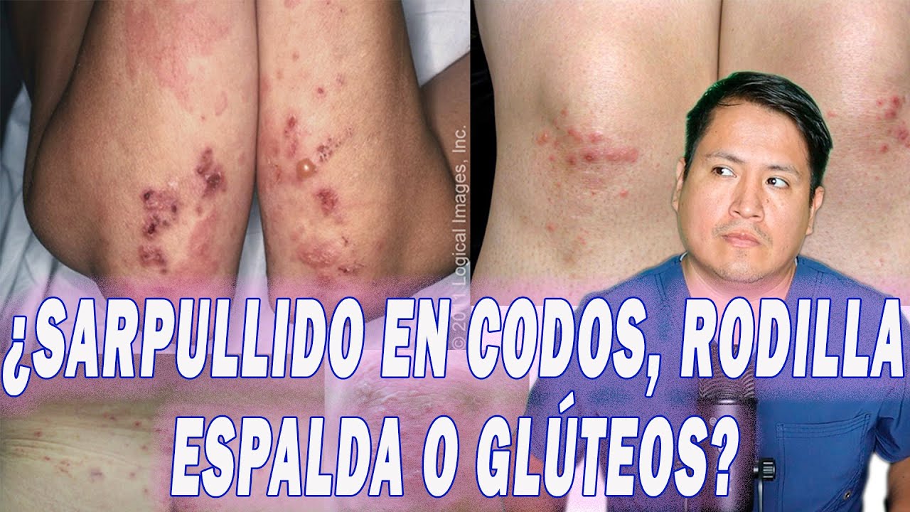 COMO ELIMINAR LA DERMATITIS HERPETIFORME #DermatitisHerpetiformis #CeliacDisease #SkinRash