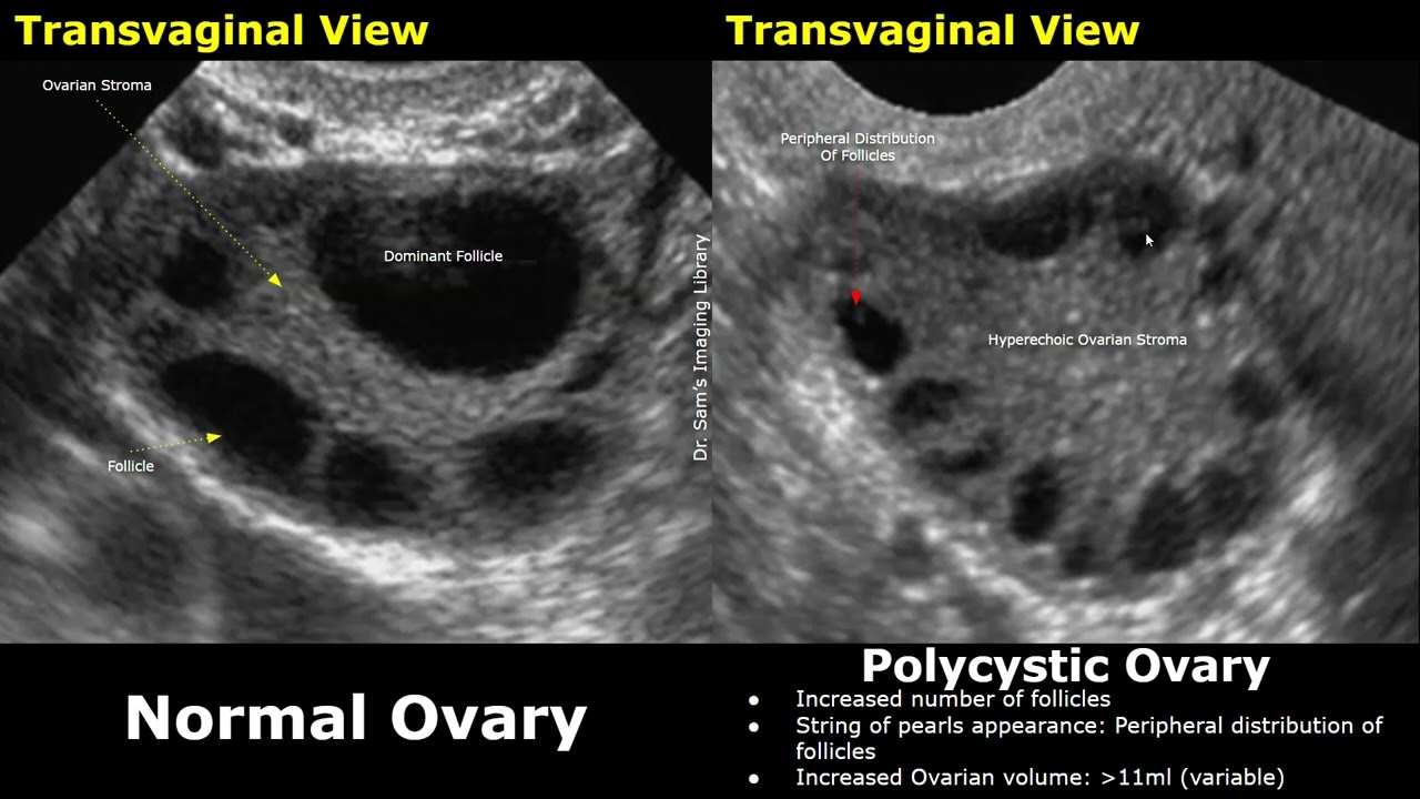 Ovary Ultrasound Normal Vs Polycystic Ovarian Syndrome (PCOS) Images | String Of Pearls Sign Ovaries