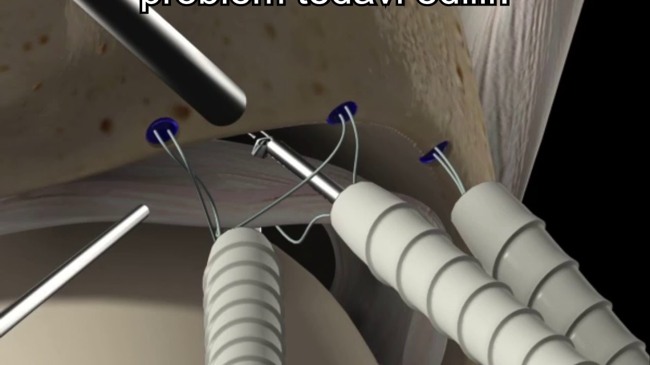 Kalça artroskopisi ile labrum tamiri (Labrum repair with hip arthroscopy)