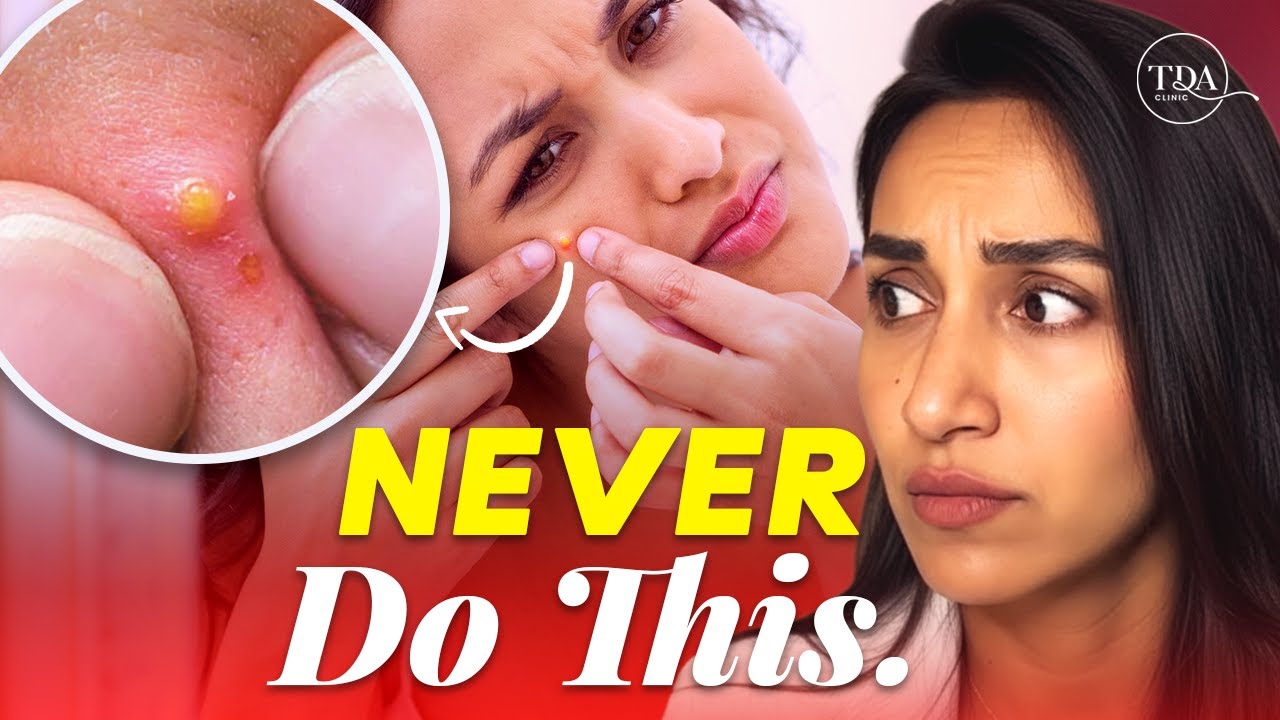 How to Treat Acne & Pimples: Causes & Solutions | By Dr. Arshi Rahul Best Skin Specialist in Pune
