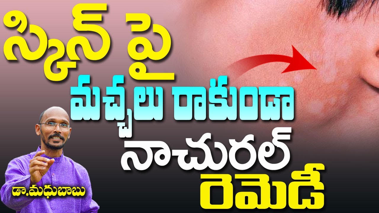 స్కిన్ పై మచ్చలు రాకుండా నాచురల్ రెమెడీ  | White Spots On Skin | Dr.Madhu Babu | Health Trends |