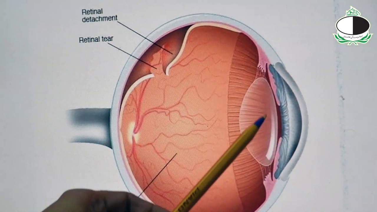 Retinal Detachment I Part 1 I Al-Shifa Trust Eye Hospital