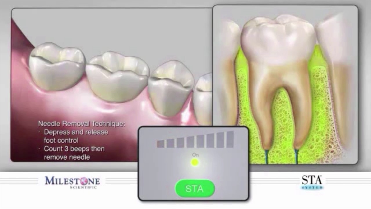 The Wand® STA Instrument - Intraligamentary PDL Injection