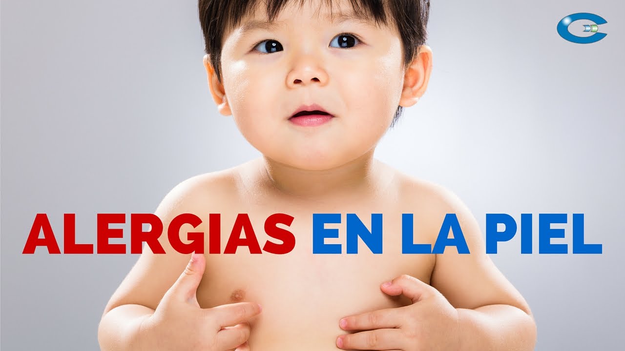 Alergias en la piel por picaduras de insectos en los niños: Prúrigo