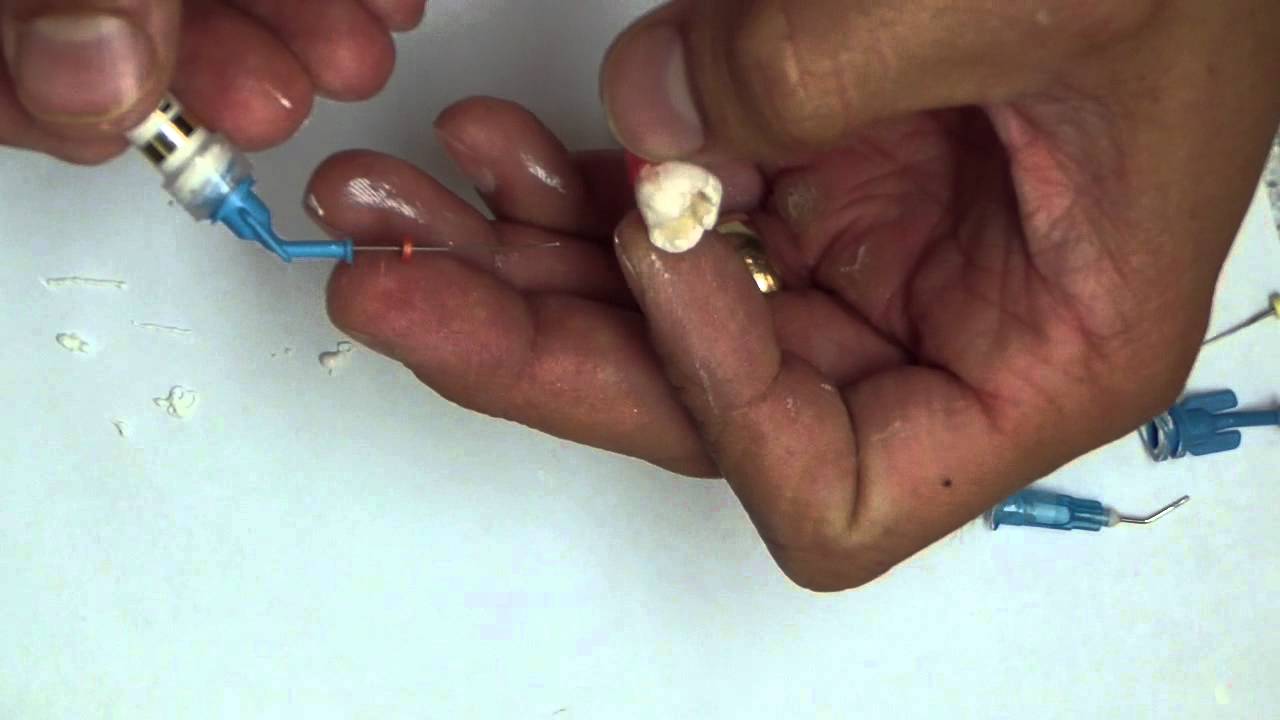 Calcium Hydroxide Placement