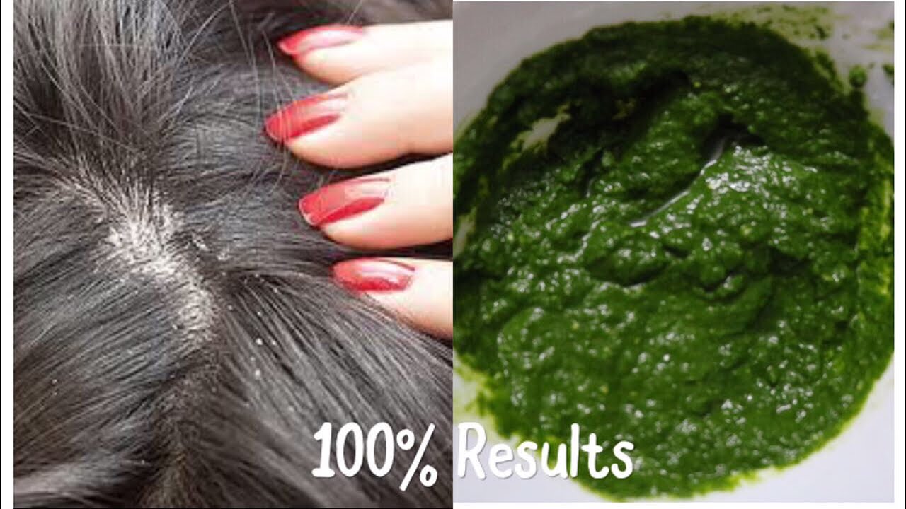 BEST SEBORRHEIC DERMATITIS SCALP TREATMENT | AYURVEDIC DANDRUFF TREATMENT 100% RESULTS IN ONE USE