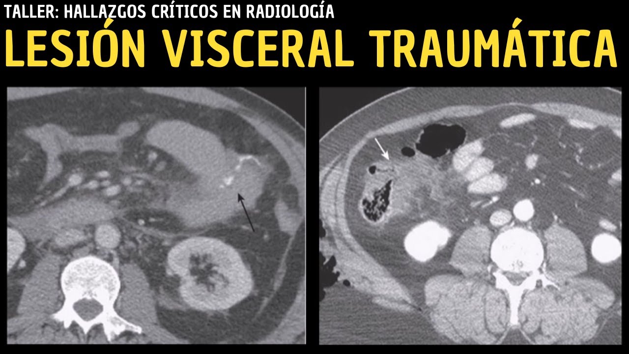 Taller Hallazgos Críticos: Lesión visceral traumática