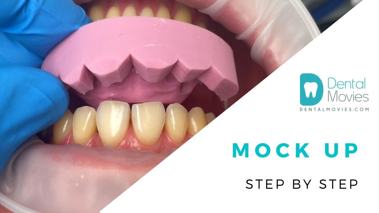 Mock up - Step by step. 🦷💡
