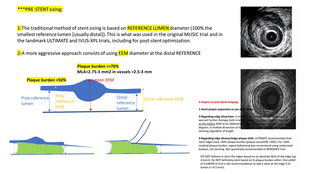 IVUS/OCT stent guidance, pre- and post-stenting